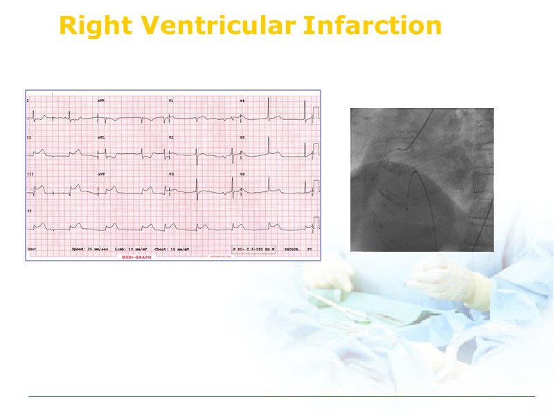 Right Ventricular Infarction